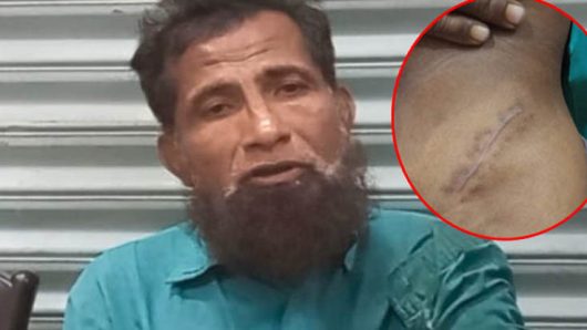 হাতভাঙা রোগীর কিডনি অপসারণ